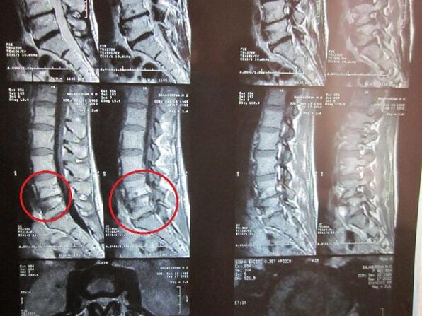 ការធ្វើរោគវិនិច្ឆ័យ oveochondrosis osteochondrosis