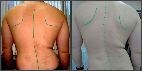 កោងនៃឆ្អឹងខ្នងដែលមានជម្ងឺ osteochondrosis