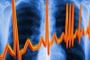 ចង្វាក់បេះដូងរបស់បេះដូងសម្រាប់ជំងឺ steochondrosis