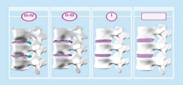 ដំណាក់កាលនៃជំងឺរលាកច្របូកច្របល់នៃមាត់ស្បូន