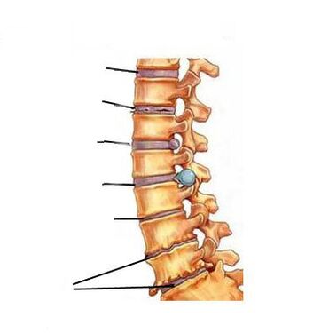 របៀបដែលជំងឺ ameochondrosis វិវឌ្ឍន៍