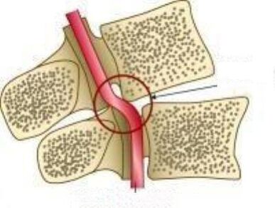 រោគសញ្ញាសរសៃឈាមស្រែកលាវ