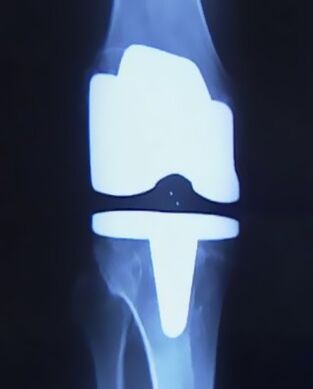 រូបភាព X -Ray នៃជង្គង់ដែលមានសិប្បនិម្មិតបន្ទាប់ពីប្រតិបត្តិការផ្លាស់ប្តូរសន្លាក់