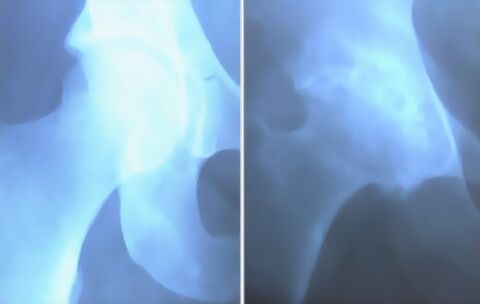 ស្នាមជាំនៃសន្លាក់នៃសន្លាក់ជង្គង់