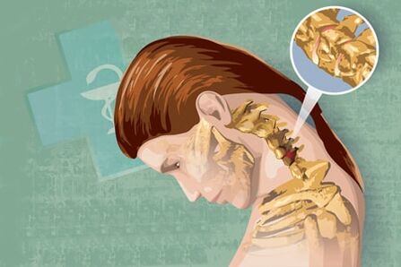 រោគសញ្ញានៃការឆ្លុះបញ្ចាំងនៃជំងឺ atebosiss